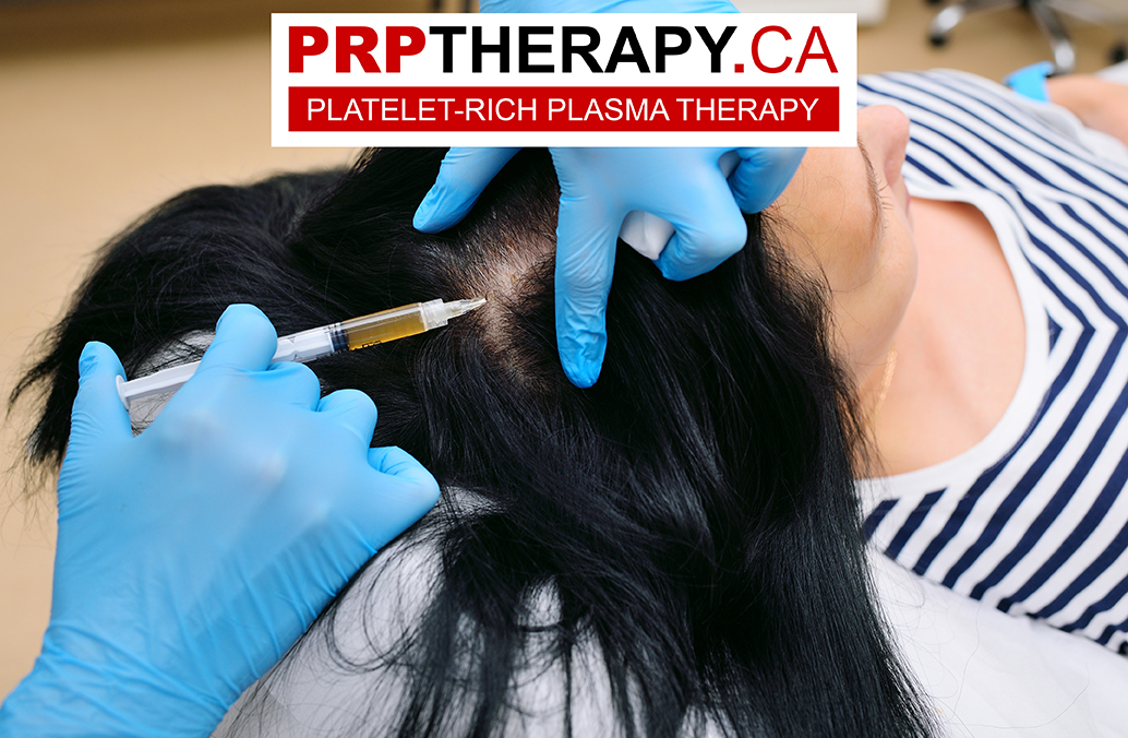 PRP - PRP cost - PRP hair loss
